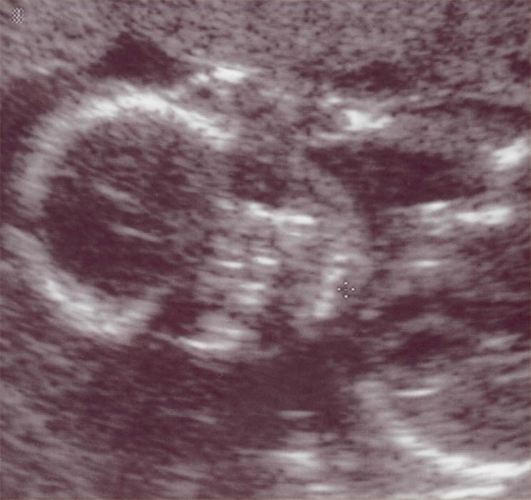 2004 11 23 Ultrasound6 - Face